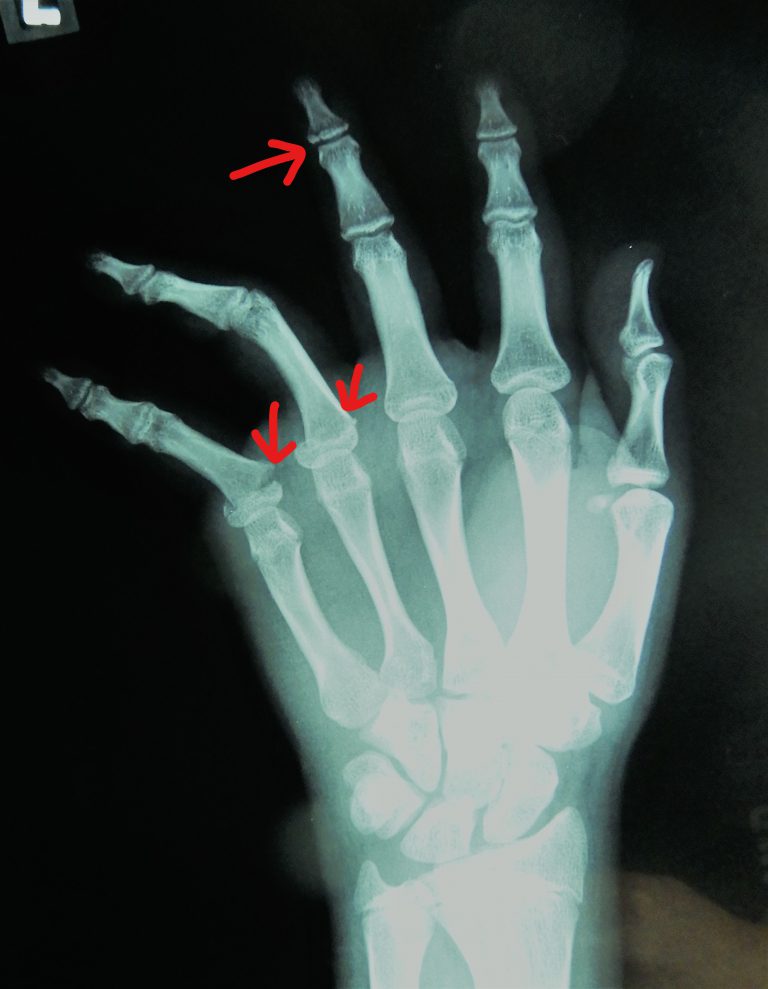 指 の 関節 骨折