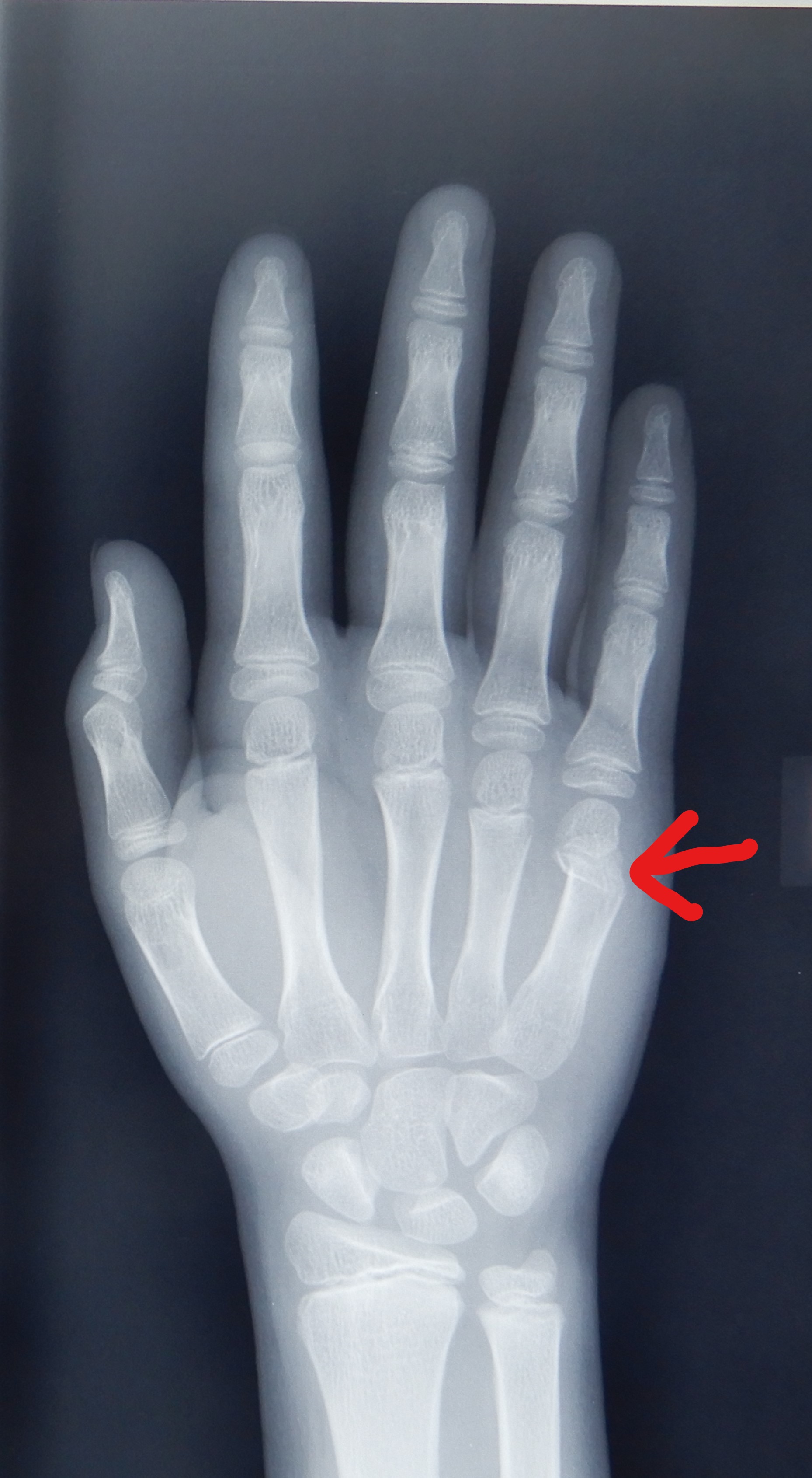右手第四掌骨斜行性骨折，拍X片图（图片在百度相册）。寻求好的治疗方案。明天用，较急 急_百度知道