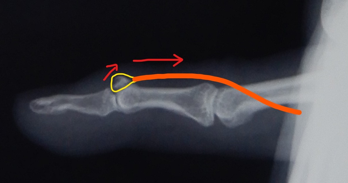 接骨院 志木｜ほねつぎの技術：手指の難しい骨折（マレットフィンガー）