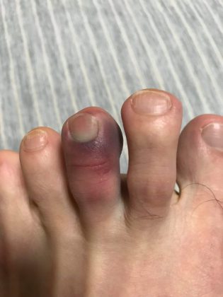 腫れ 足の指先