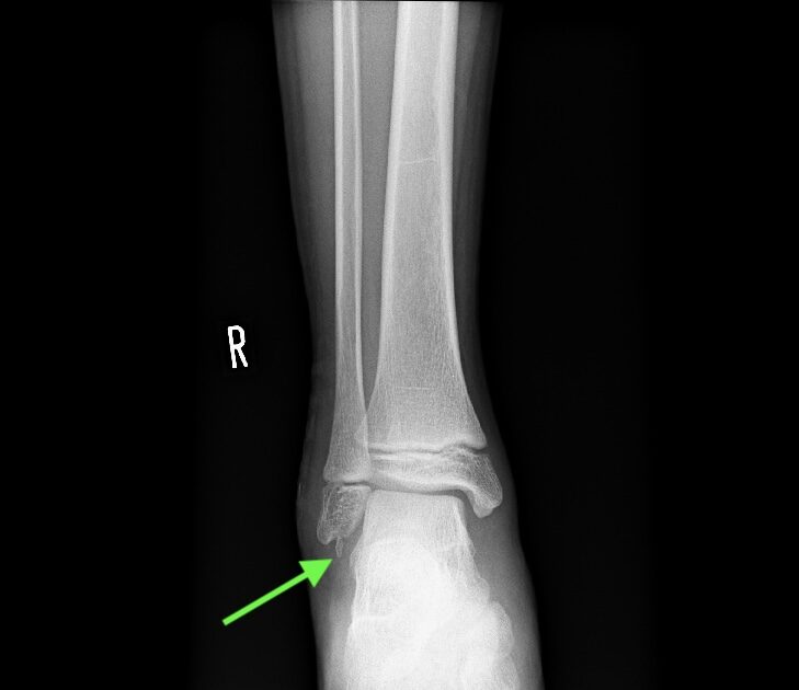 左足首腓骨骨折 リハビリ用 26.5〜27.5〜28 左足首腓骨骨折 リハビリ用